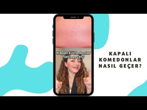 Kapalı komedonlar nasıl geçer? - Doç. Dr. Ezgi Özkur #shorts