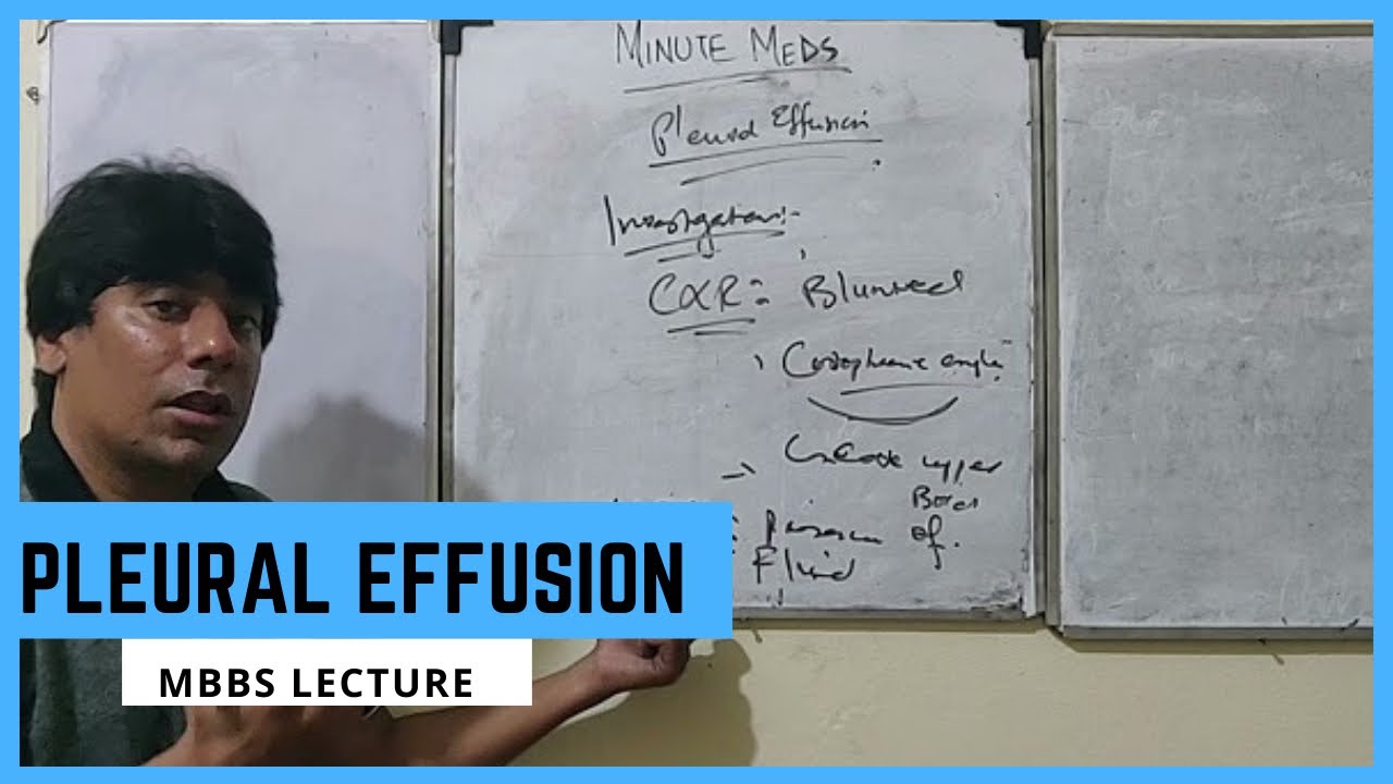 Pleural Effusion Full Lecture URDU HINDI MBBS Lecture YouTube pleural-effusion-full-lecture-urdu-hindi-mbbs-lecture-youtube