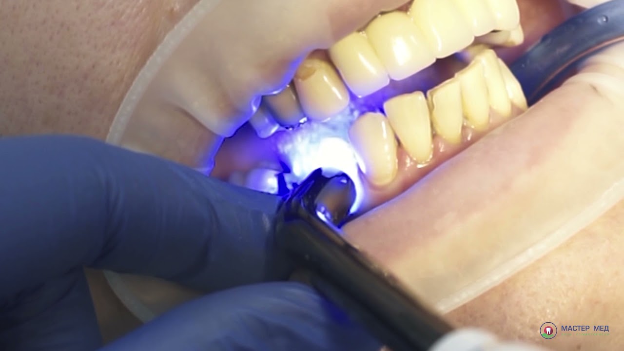Процесс установки пломбы. Стоматология Мастер Мед. Макро съёмка
