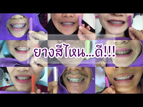 วีดีโอ: วิธีการเลือกสีของเหล็กจัดฟัน: 14 ขั้นตอน (พร้อมรูปภาพ)