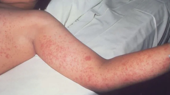 Covering Your Health: Texas Measles Outbreak Grows