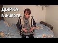 ДЫРКА В ЖИВОТЕ//ЛЮДМИЛА ХОЧЕТ ВЕРНУТЬ СВОЕ ЗДОРОВЬЕ