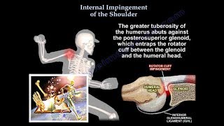 Internal Impingement  of the shoulder- Everything You Need To Know - Dr. Nabil Ebraheim