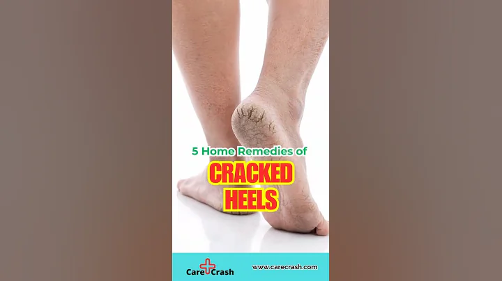 5 Powerful Home Remedies for Cracked Heels | #carecrash