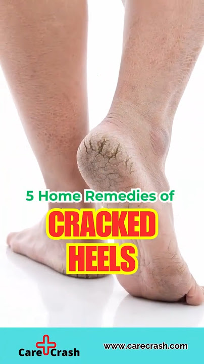 5 Powerful Home Remedies for Cracked Heels | #carecrash
