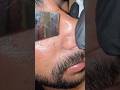 Men’s Nose Extractions