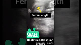 Pregnancy Ultrasound showing femur length!BPD!Obstetric Ultrasound!#123ultrasonography#baby#india