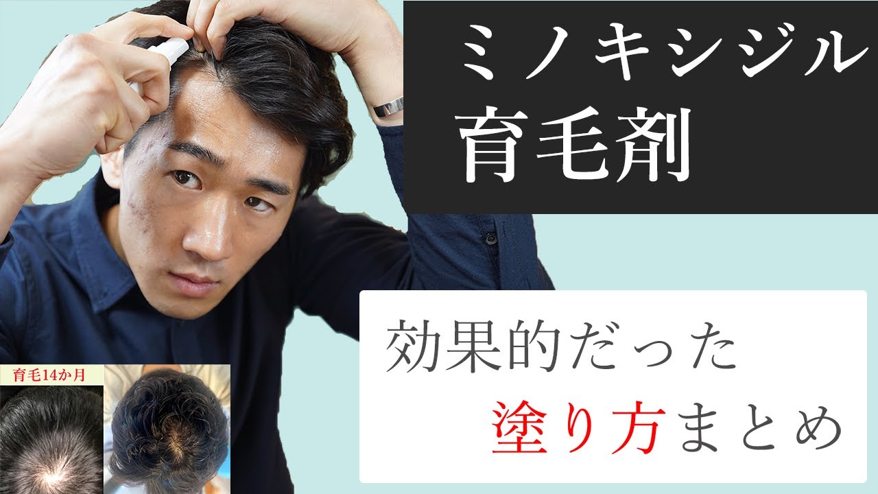 毎日頭皮にセルフダーマローラーしたら育毛 発毛効果がヤバかった ミノキシジルとの効果的な使い方まで徹底解説 キヨキヨの美容ブログ 毎日頭皮にセルフダーマローラーしたら育毛 発毛効果がヤバかった ミノキシジルとの効果的な使い方まで徹底解説 キヨキヨの美容ブログ