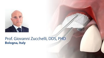 Root Coverage of a single recession defect