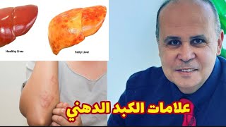 علامات غريبه في جسمك تخبرك بوجود دهون الكبد 👈👌كسل وظايف الكبد