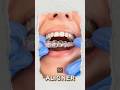 التقويم المتحرك الشفاف Aligners 