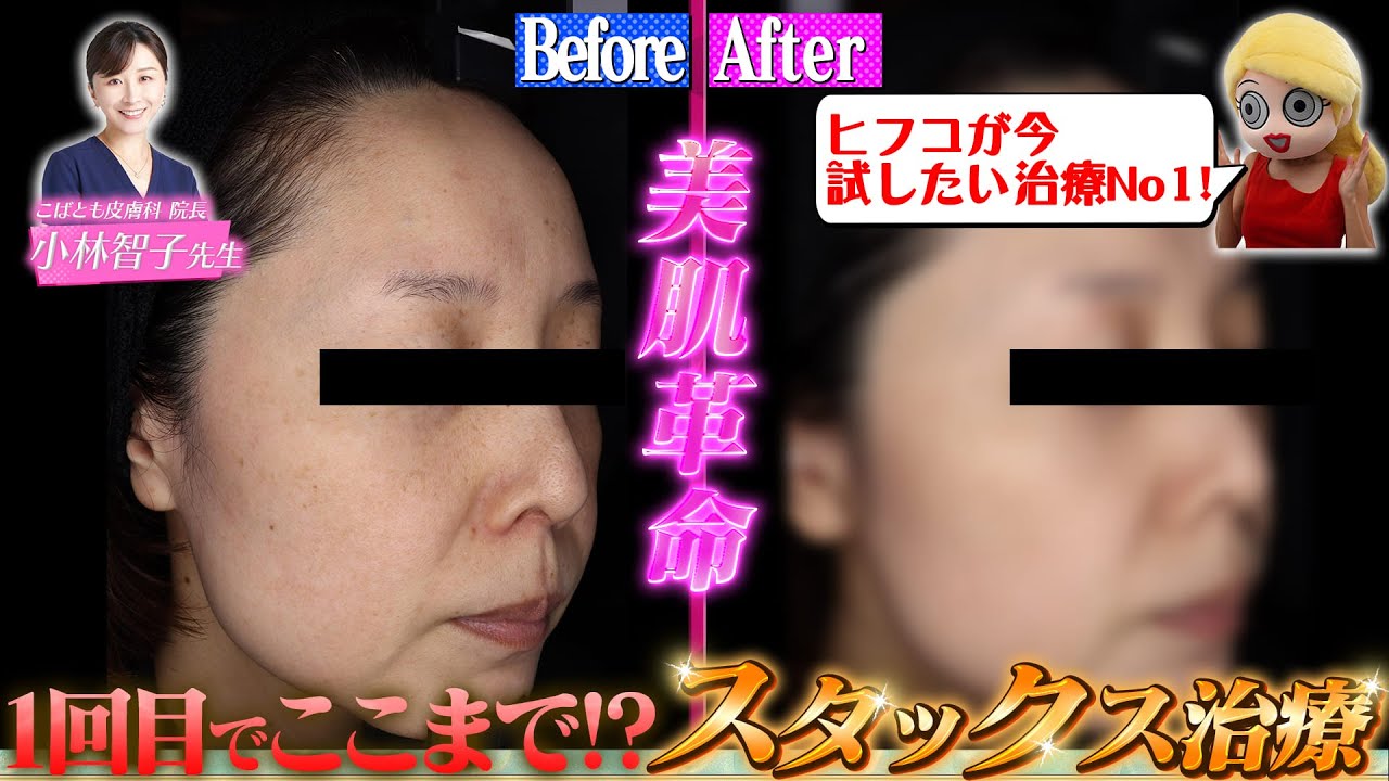 【1回でこの効果⁉️️】◯◯◯◯治療をガチレポ