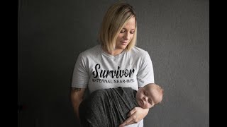 A Maternal Near-Miss Survival Story (Secondary Postpartum Hemorrhage)