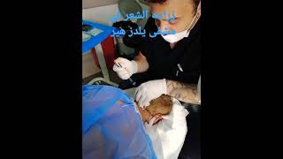 زراعه الشعر يلدز هير