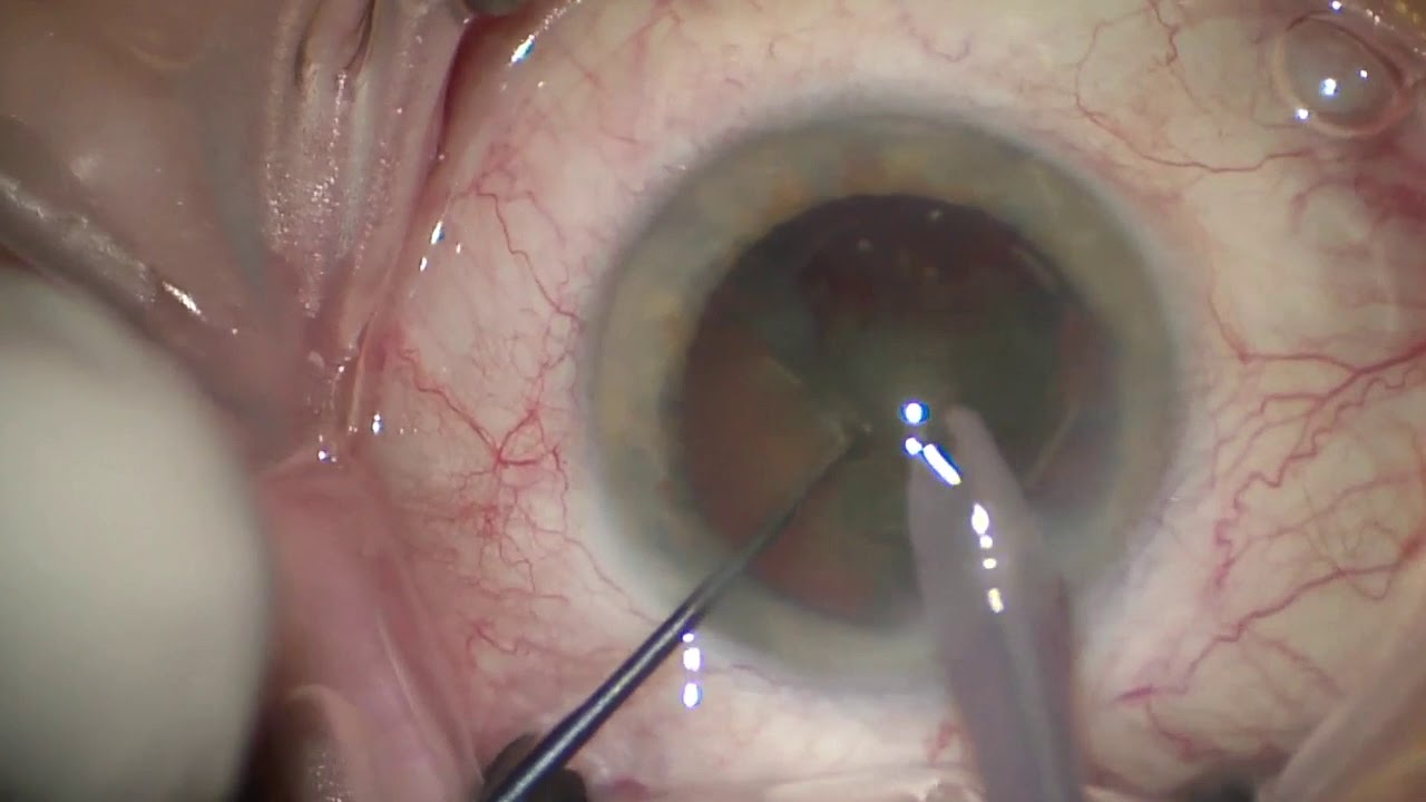 Sleeping Position After Cataract Surgery