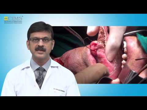CIMS HOSPITAL - Dr. Darshan Bhansali - Mouth Cancer Causes And Treatment