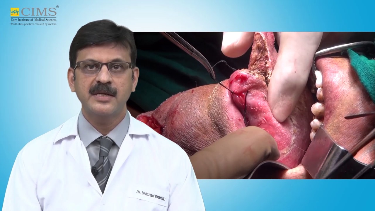 Cims Hospital Dr Darshan Bhansali Mouth Cancer Causes And Treatment Youtube