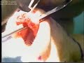 Cosmetic Surgeon Toronto Rhinoplasty Surgery by Dr.Solomon