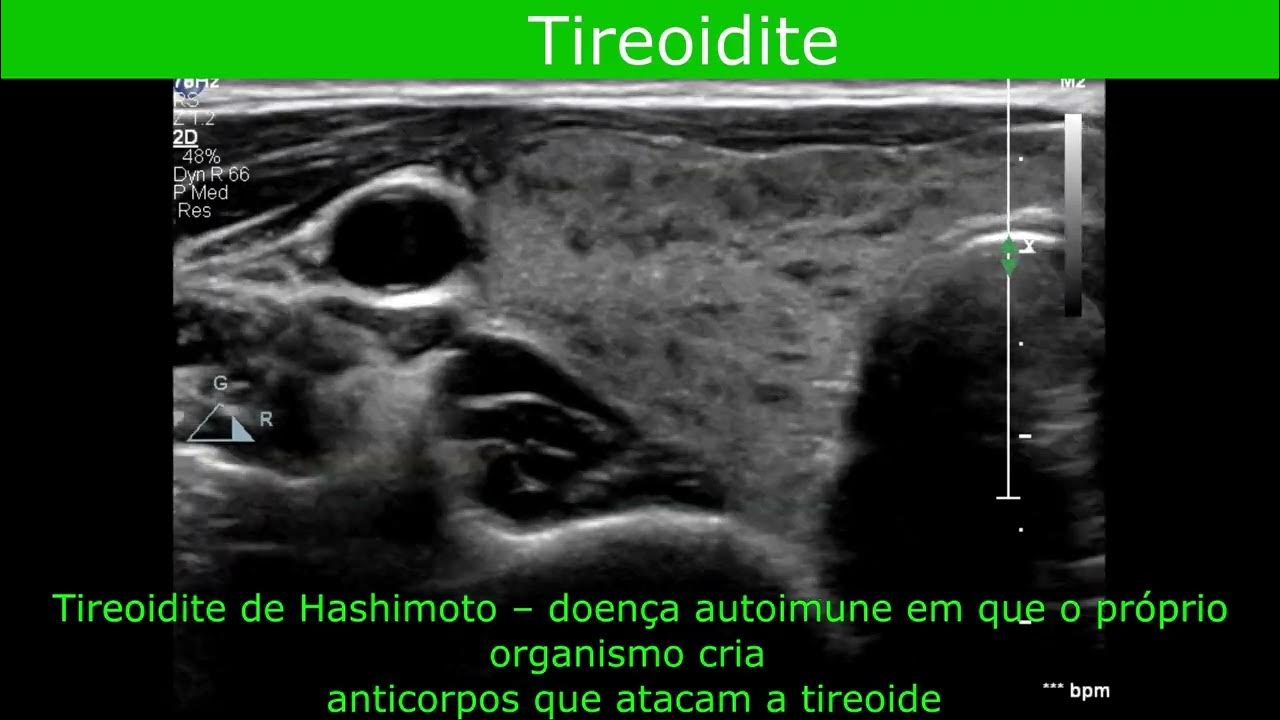 Ultrassonografia Tireoide Tireoidite Hashimoto YouTube