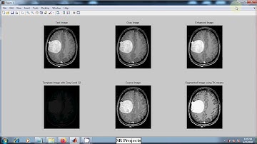 Brain Tumor Detection and Statistical Analysis of Tumor Region | Medical Image Processing | MATLAB