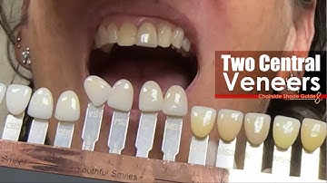 Two Central Veneers with Chairside Shade Guide 8.0 & App