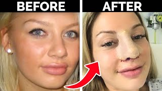Celebrity Do I Regret My £10,000 Nose Job? Net Worth