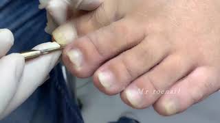 Shape adjustment   Best way for nail repair by BABI TOYS 1 view 3 years ago 3 minutes, 24 seconds