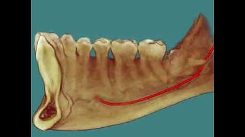 Impacted Third Molars 3D CBCT Scan Animation