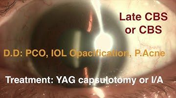 Late Capsular Distention (Capsular block ) Syndrome Management