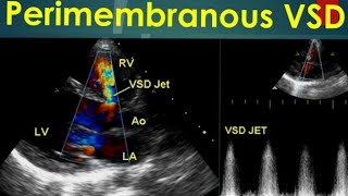 Echocardiography in perimembranous ventricular septal defect by Babita