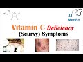 Vitamin C Deficiency (Scurvy) Symptoms (ex. bad teeth, fatigue), Why symptoms happen & who gets them