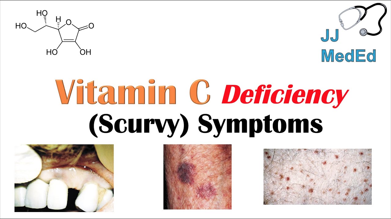 Vitamin C Deficiency Scurvy Symptoms Ex Bad Teeth Fatigue Why Symptoms Happen Who Gets Them