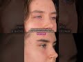 Эндоскопическая подтяжка лба и виска
