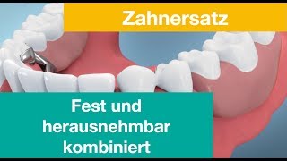 Kombinationszahnersatz