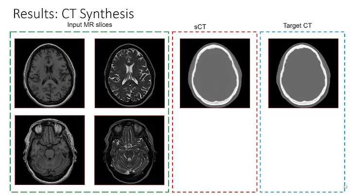 Accurate Estimation of TIV in MRI using a Multi-tasked Image-to-Image Translation Network
