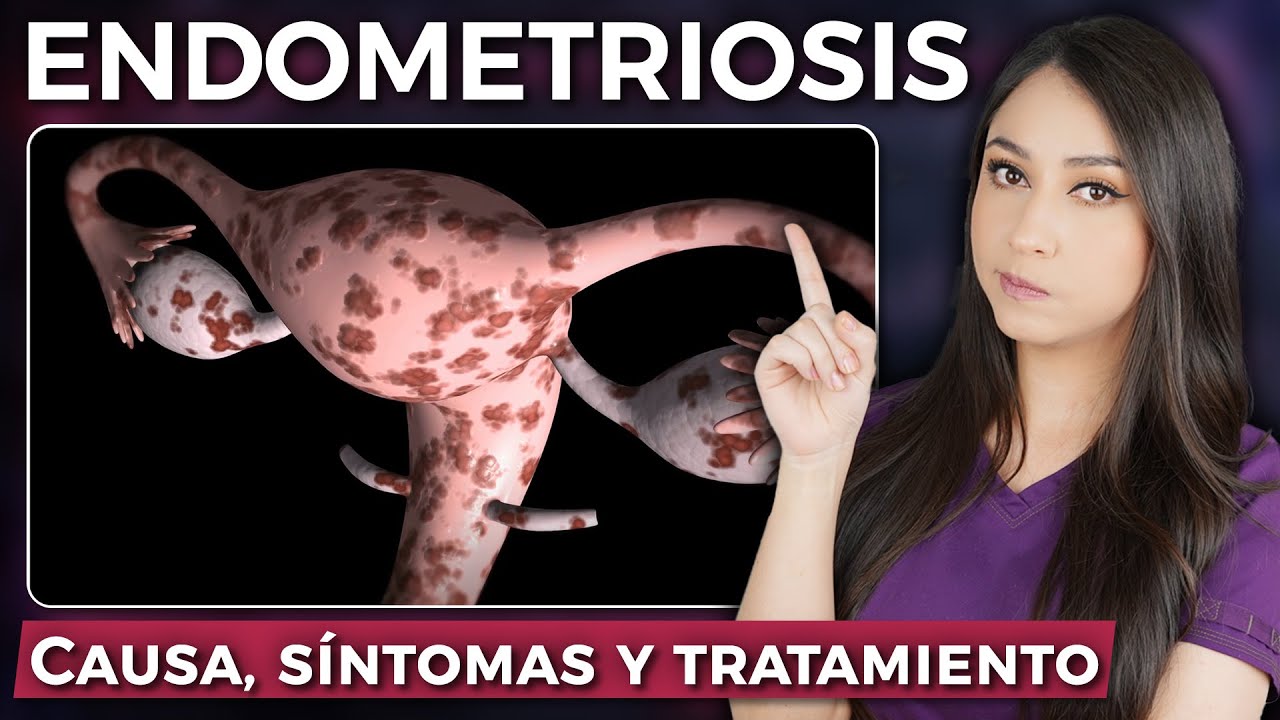ENDOMETRIOSIS:  Causas, síntomas y tratamiento l Dra. Pau Zúñiga 👩🏻‍⚕️
