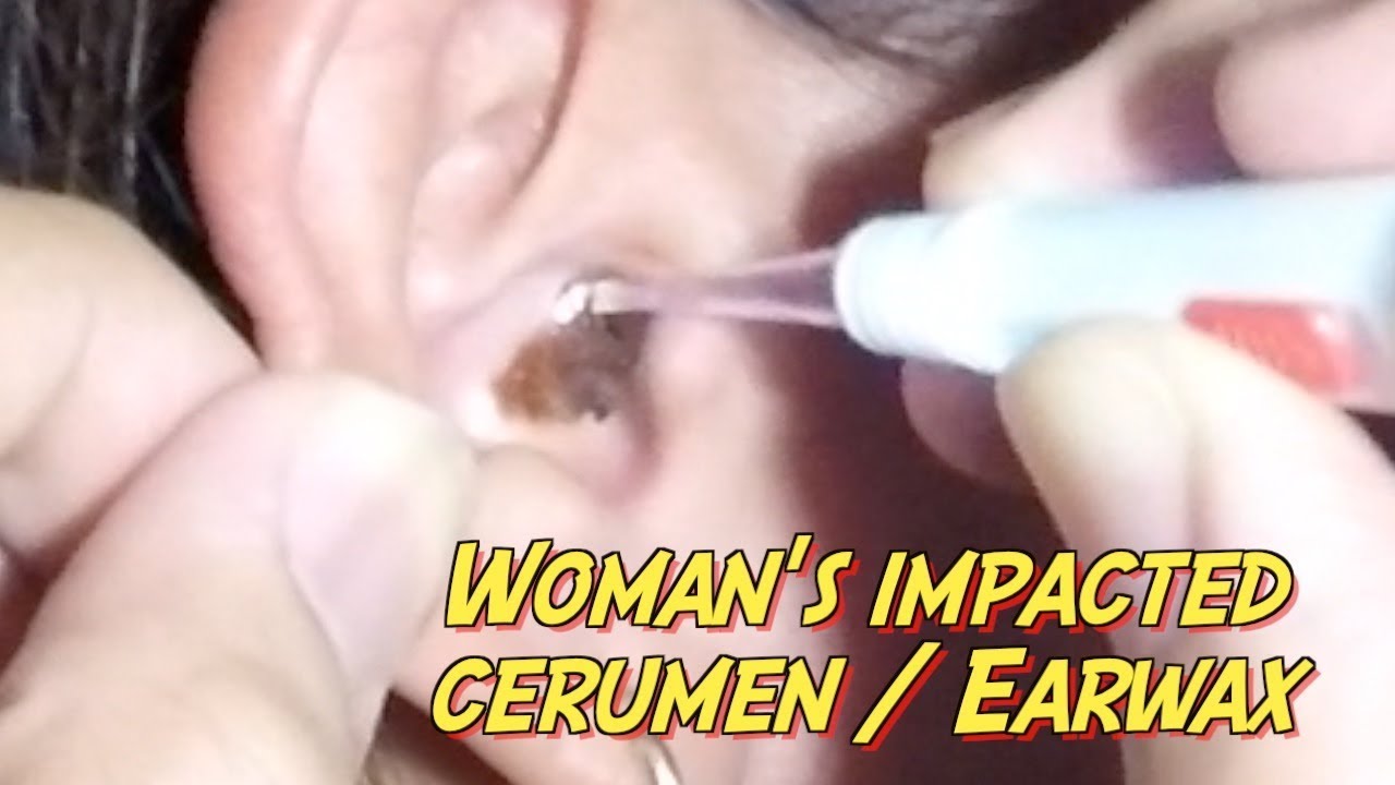 removal of impacted ear wax removal of impacted ear wax