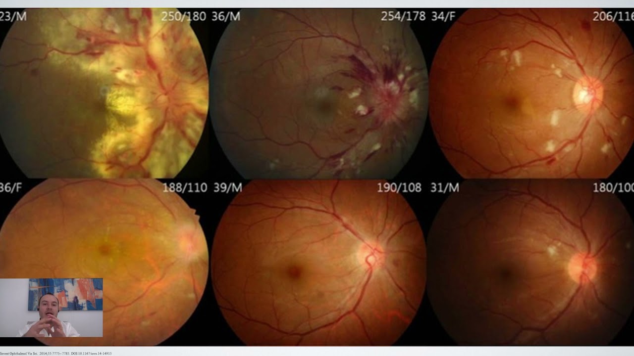 Hallazgos en el fondo del ojo en enfermedad cardiovascular