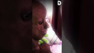 Niños en la India enfrentan un síndrome de envejecimiento prematuro