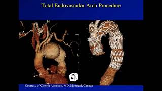 STS University 2018 - Course 2: TEVAR and Aortic Arch Debranching Procedures screenshot 5