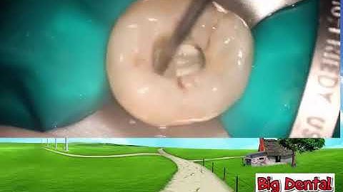 B.D: Mở tủy răng cối lớn hàm dưới