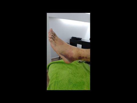 Video: Maneras sencillas de tratar un hematoma en el talón: 11 pasos (con imágenes)