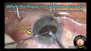 CataractCoach™1802: when floppy iris syndrome gets ugly