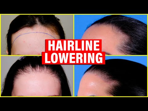 Hairline Lowering: Choosing between a Hair Transplant and Surgical Hairline Advancement