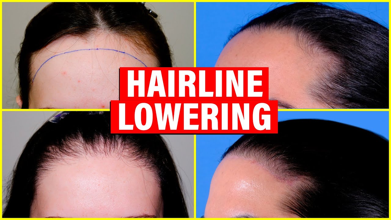 Lowering the female hairline two options in treatment  Hair Transplant  Forum International