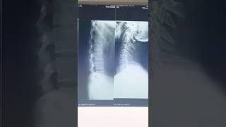 Lumber Spine X-ray on 100MA x-ray machine #ytshort #medicalimaging #xray #xrays