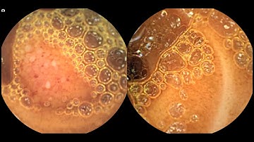 MiroCam MC2000 Double Headed Capsule Endoscopy Jejunal Lesion left side