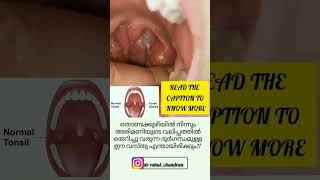 Tonsil Stones or Tonsiloliths| What are They | Symptoms | Home Remedies*