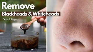 Remove Blackheads & whiteheads | Facial Steaming to Get Clear Flawless Skin | Remove Pimples