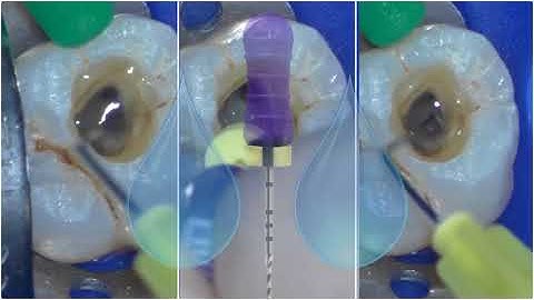 WaveOne® Gold Small Canals Technique with Dr. Willy Pertot | Dentsply Sirona